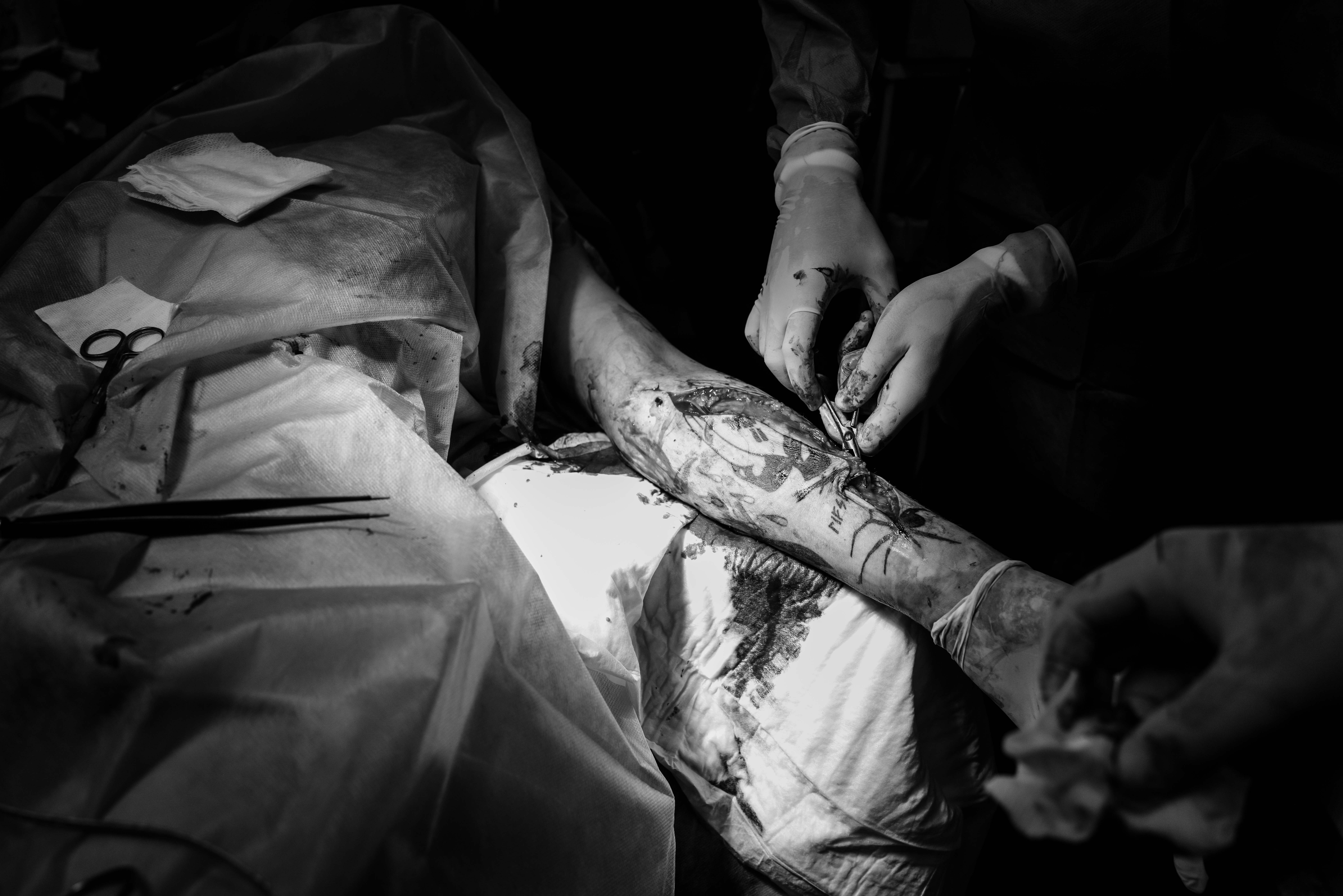 Borova, Ukraine - A 23 year soldier arrives from the Kupiansk battlefield area to the first Medical Hospital for emergency treatment. He was hit by an FPV drone while on mission. The shrapnel wounds need to be extracted immediately or the loss of the forearm will be innevitable. Doctors are not sure they will manage to avoid amputation but the the operation is successful after almost two hours.